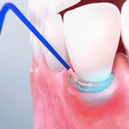 Pocket-X® Gel